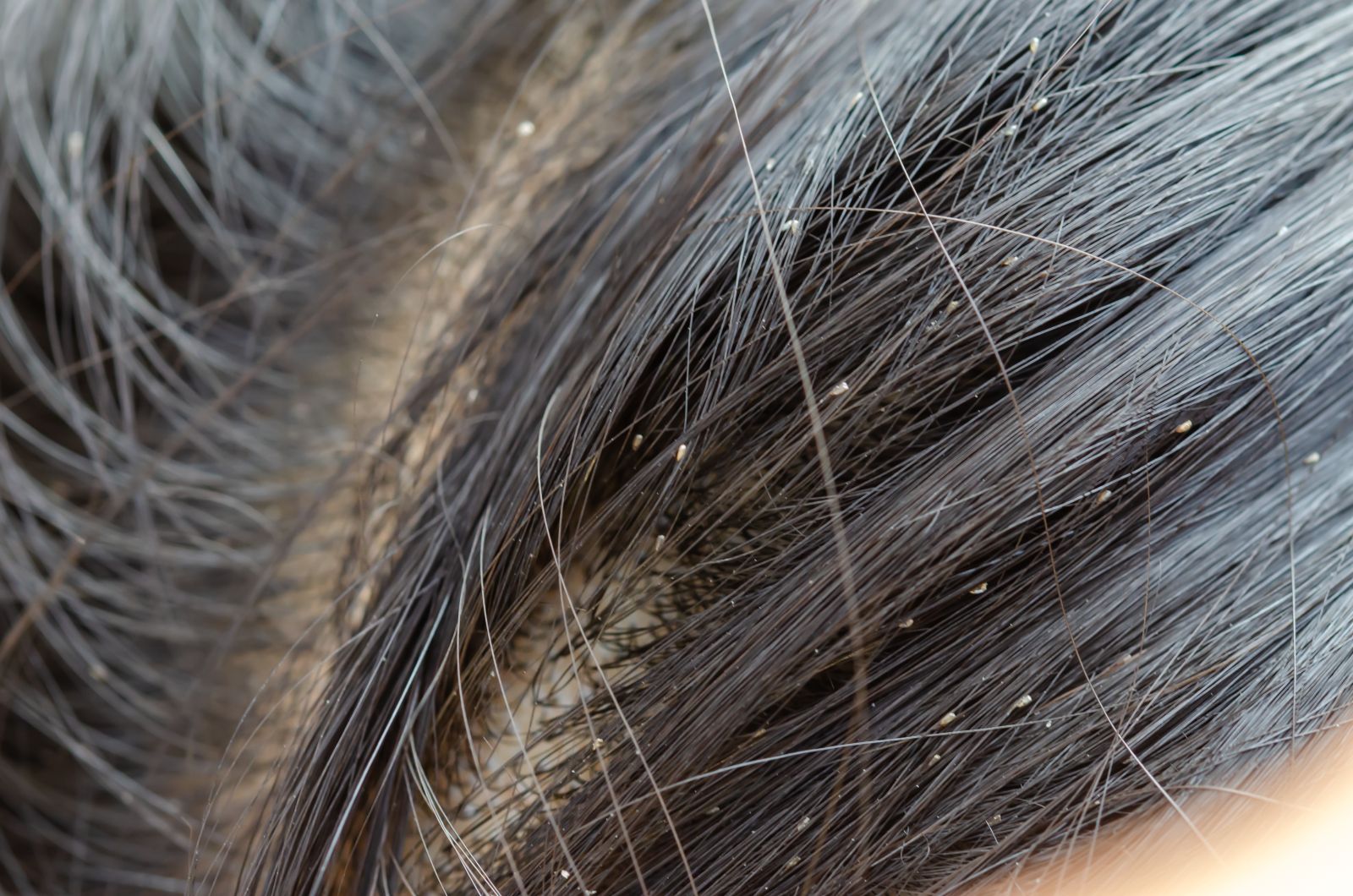 Как выглядят гниды на волосах: фото