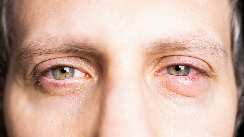 Аллергия на глазах: симптомы и проявления