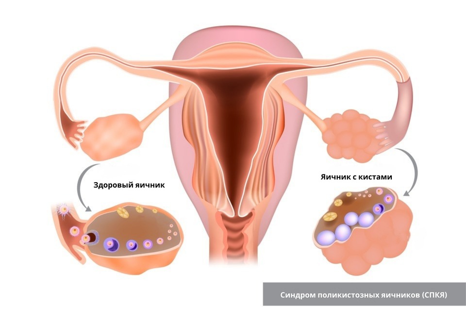 Что такое киста яичника и как она выглядит