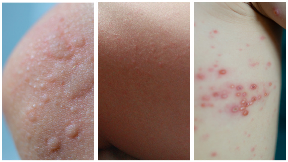 Как отличить сыпь при ветрянке от крапивницы и потницы