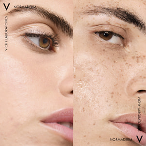 Вода мицеллярная VICHY (Виши) Нормадерм очищающая для проблемной кожи 200 мл